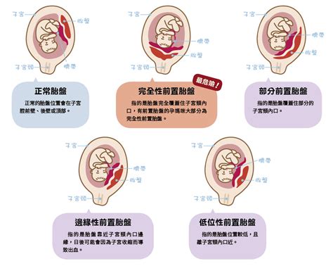 胎盤靠近子宮頸|前置胎盤、前壁胎盤、低置胎盤傻傻分不清？一張圖就弄懂了！